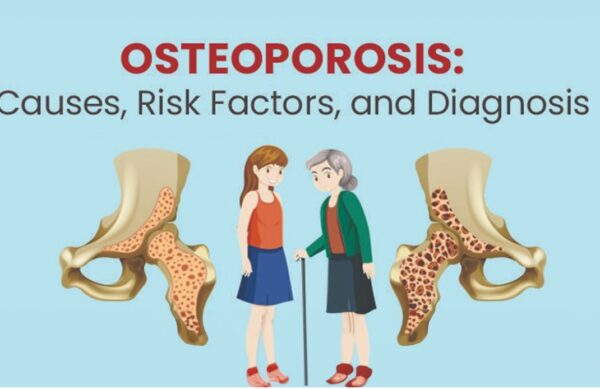 Understanding-Osteoporosis-Causes Understanding-Osteoporosis-Causes